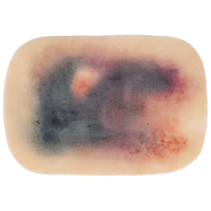 TraumaSim Self-Adhesive Large Haematoma